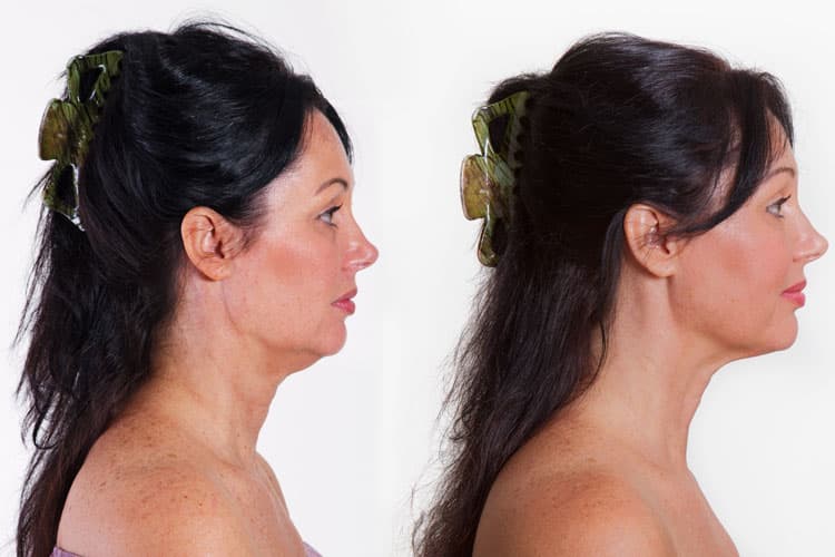 My Face Lift: Il massaggiatore per collo e mento che aiuta a ridurre la dimensione del doppio mento